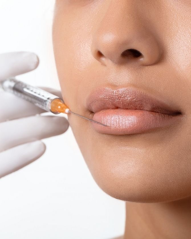 augmentation des lèvres à l'acide hyaluronique