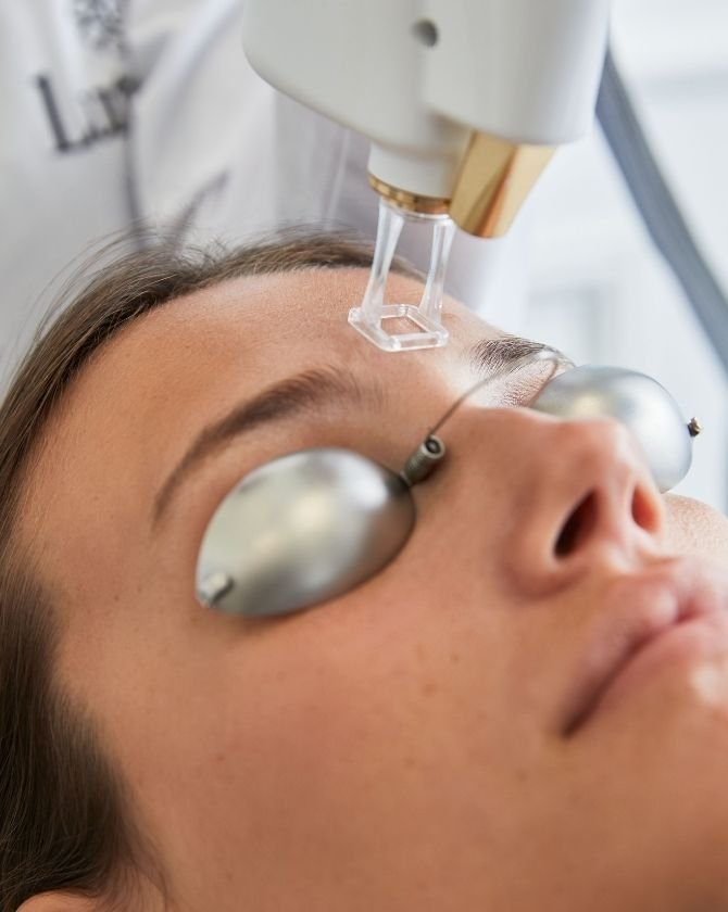 Traitement pour l'Excès de sébum avec le laser resurfaçant