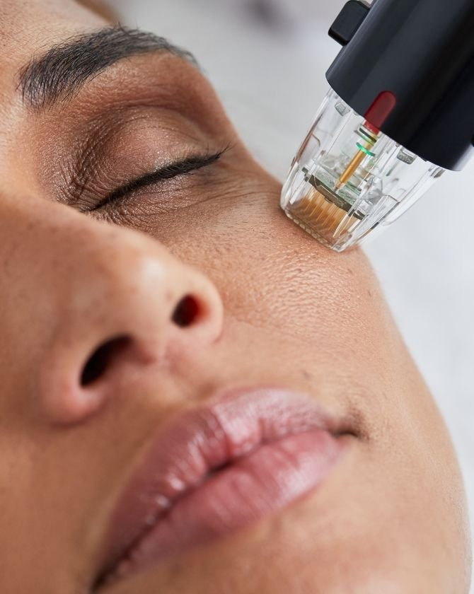 traitement visage femme par microneedling maison lutetia