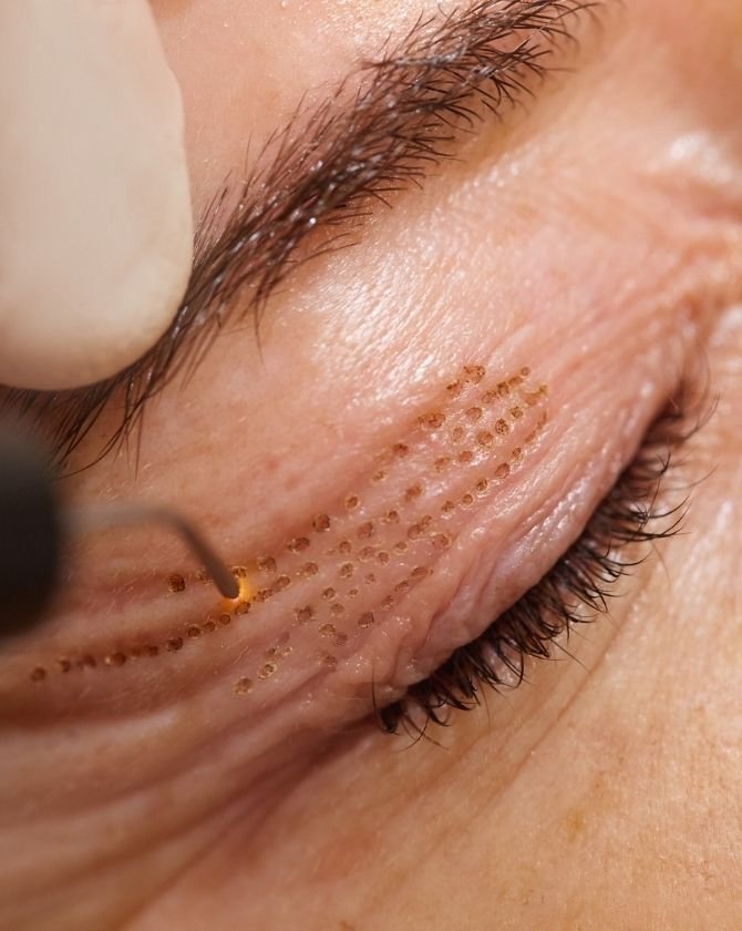 traitement par laser des paupière qui tombe