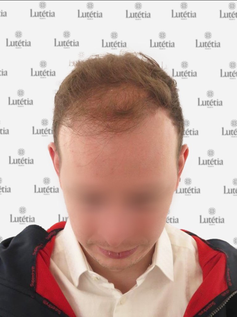 résultats de greffe capillaire chez Maison Lutetia Paris