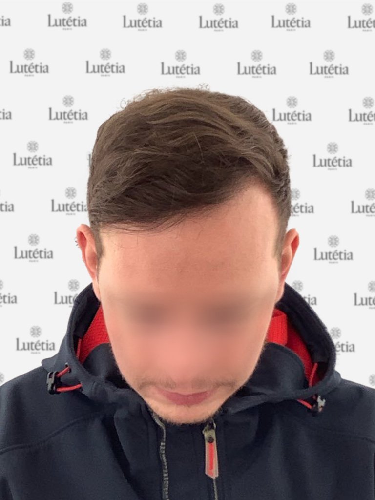 résultats de greffe capillaire chez Maison Lutetia Paris