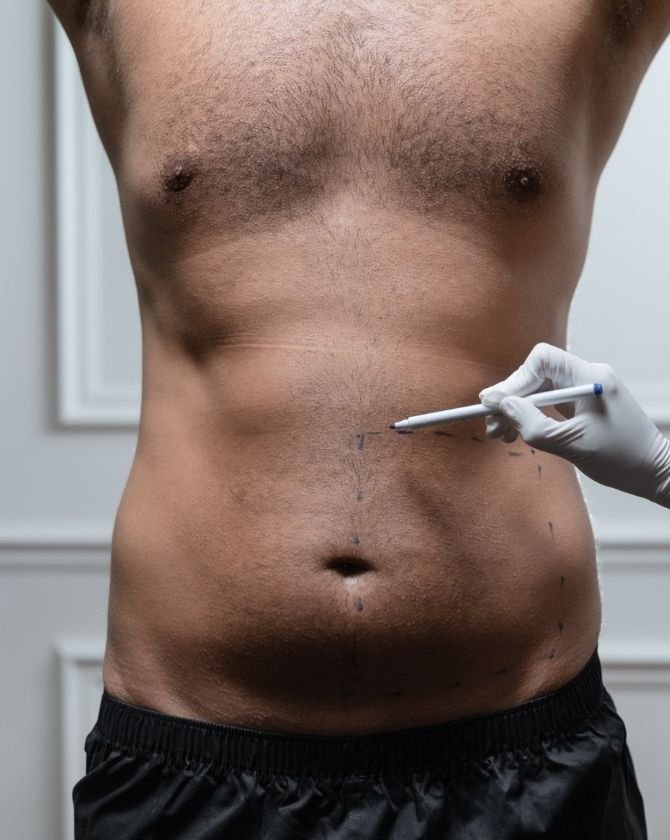 Associer la cryolipolyse à une nutrition ciblée : le combo gagnant
