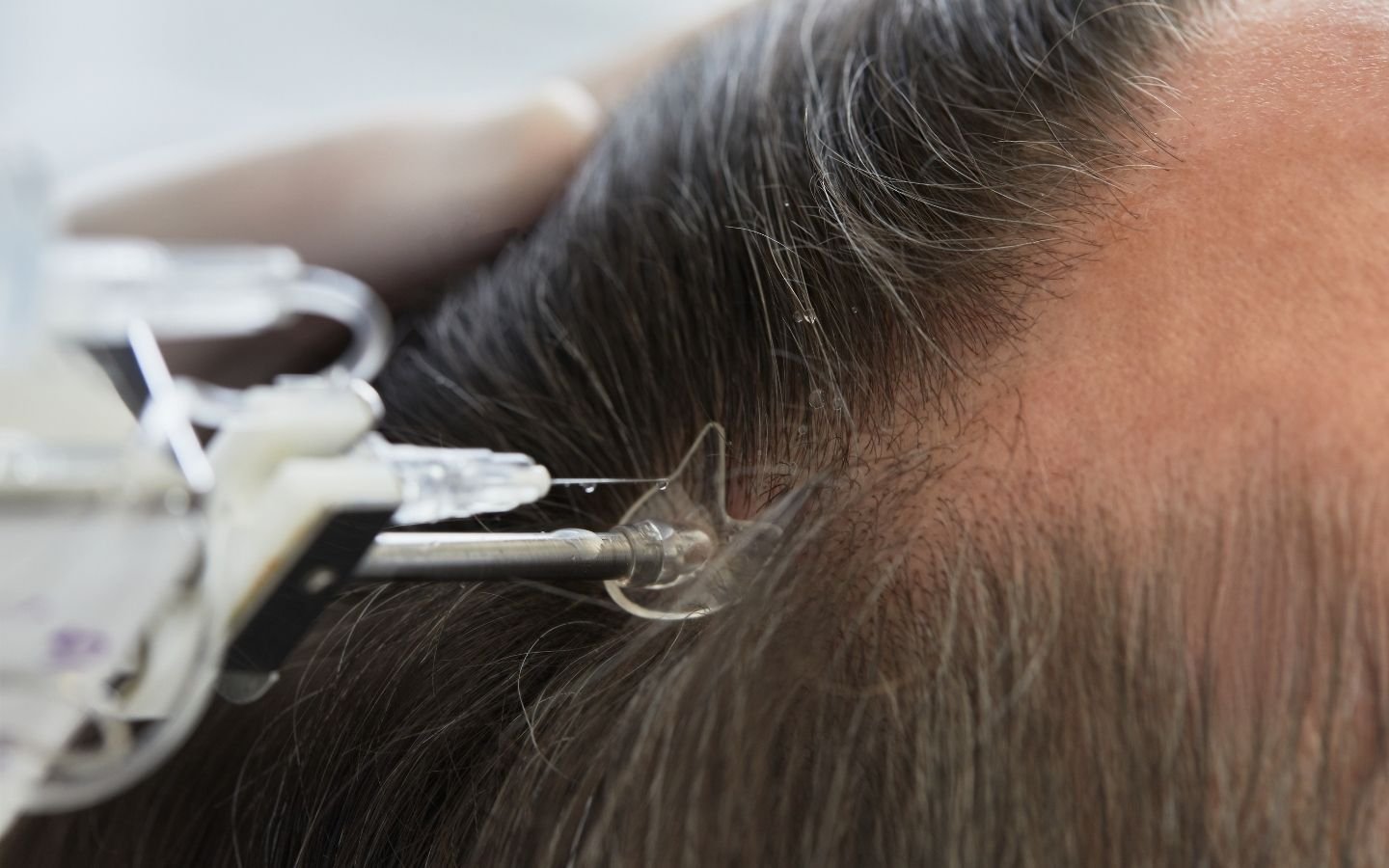 Mésothérapie des cheveux