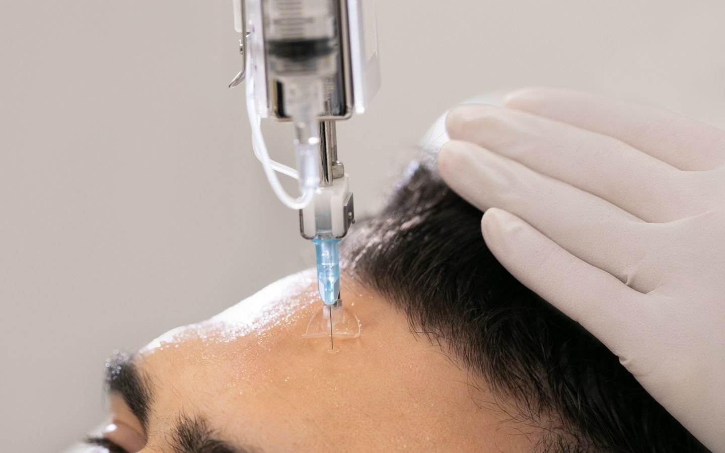 Mésolift de la peau