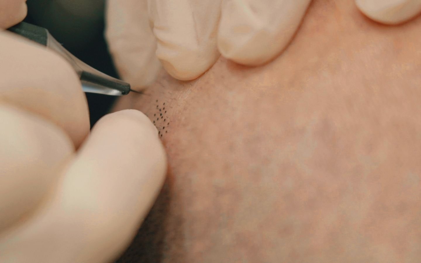 Micropigmentation capillaire – solution esthétique