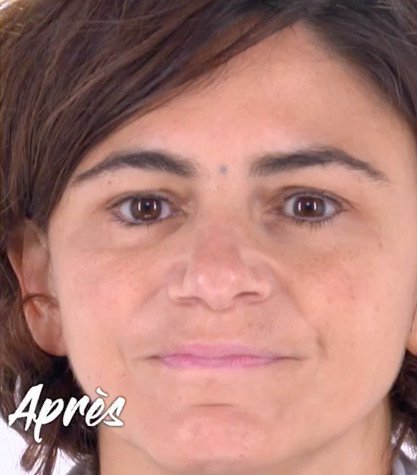 Visage lissé d'Emmanuelle après injections à la Maison Lutétia