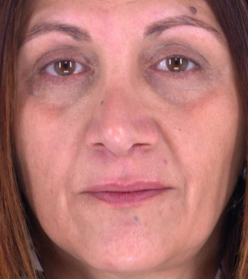 pose de fil tenseur résorbables pour retendre la peau du  visage
