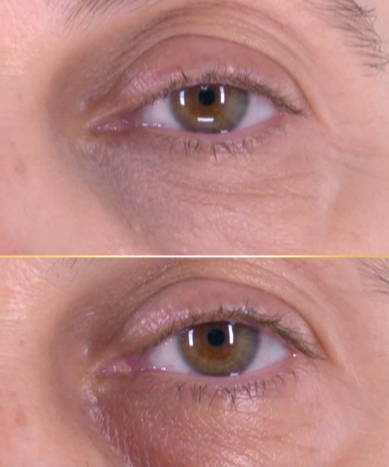 injections d’acide hyaluronique pour combler les cernes de Sandrine
