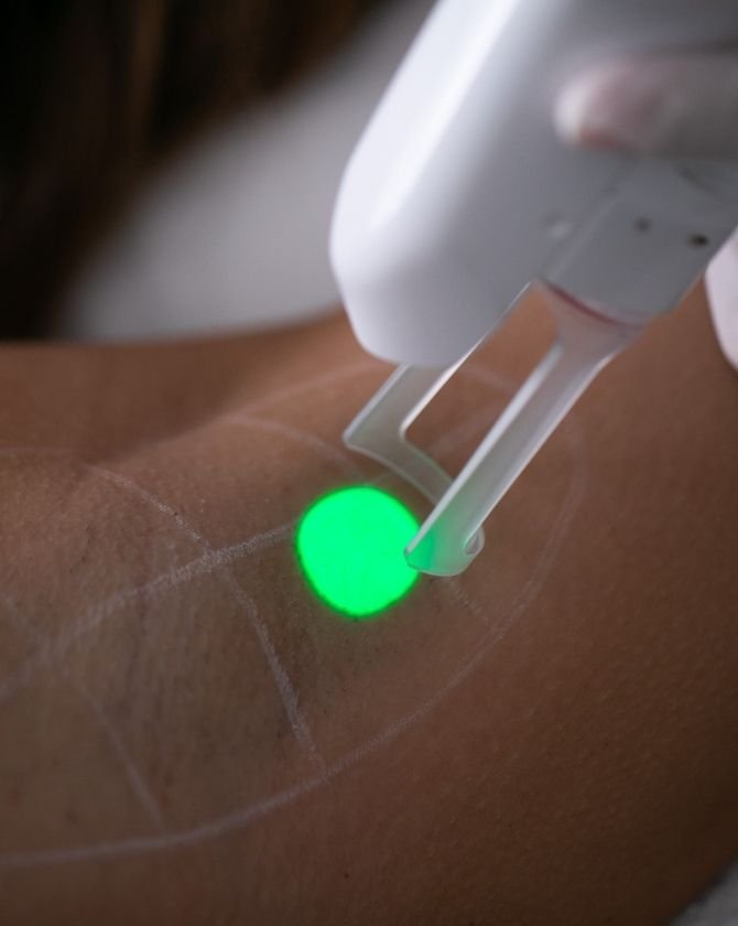 Application du laser Nd:YAG sur la peau noire, ciblant les follicules pileux sans affecter la peau environnante