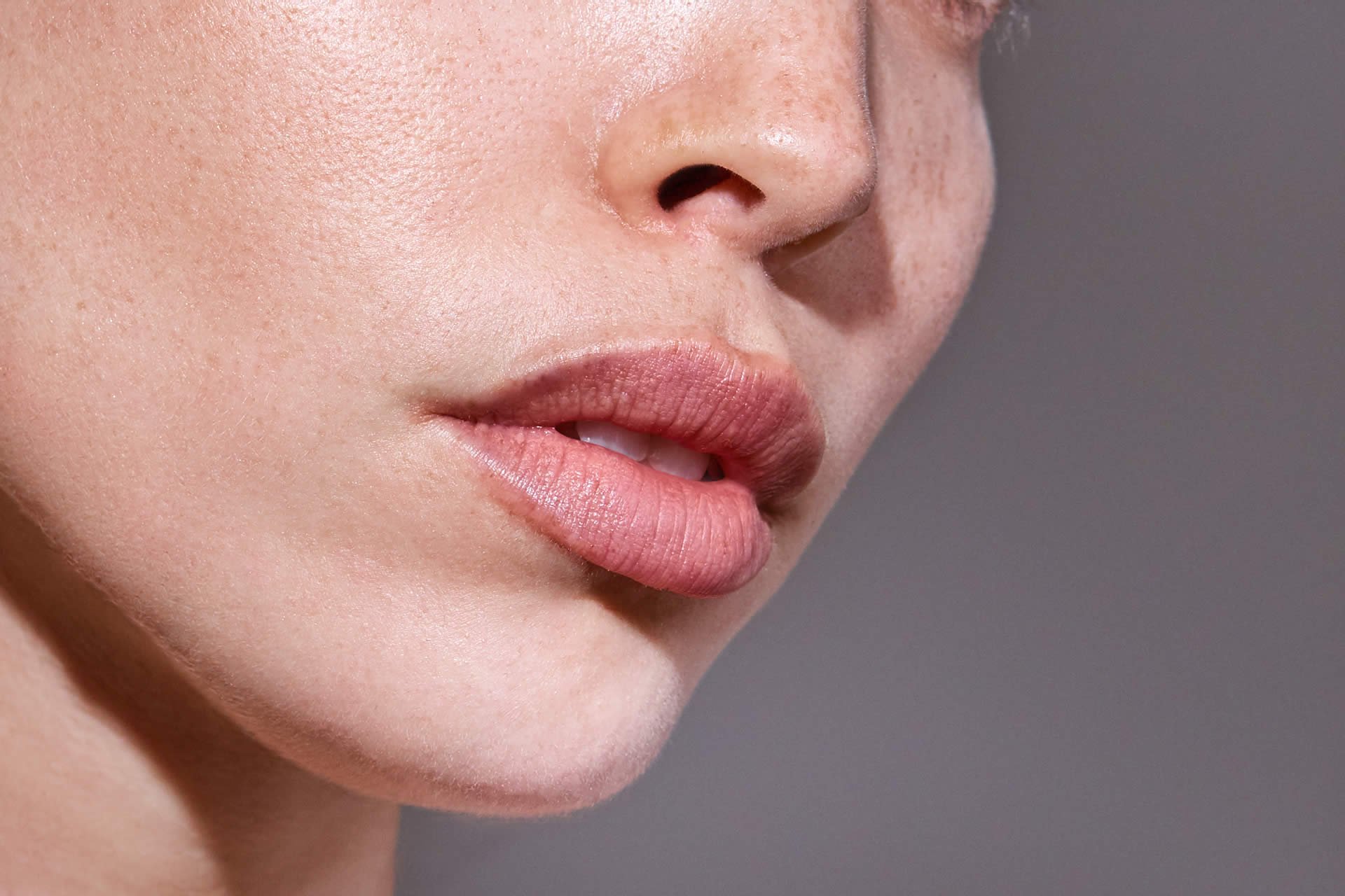 Effet naturel du Lip Flip sur le sourire d'une patiente