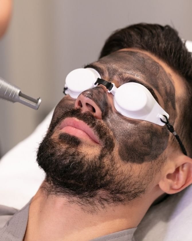 Le Carbon Laser Peel
