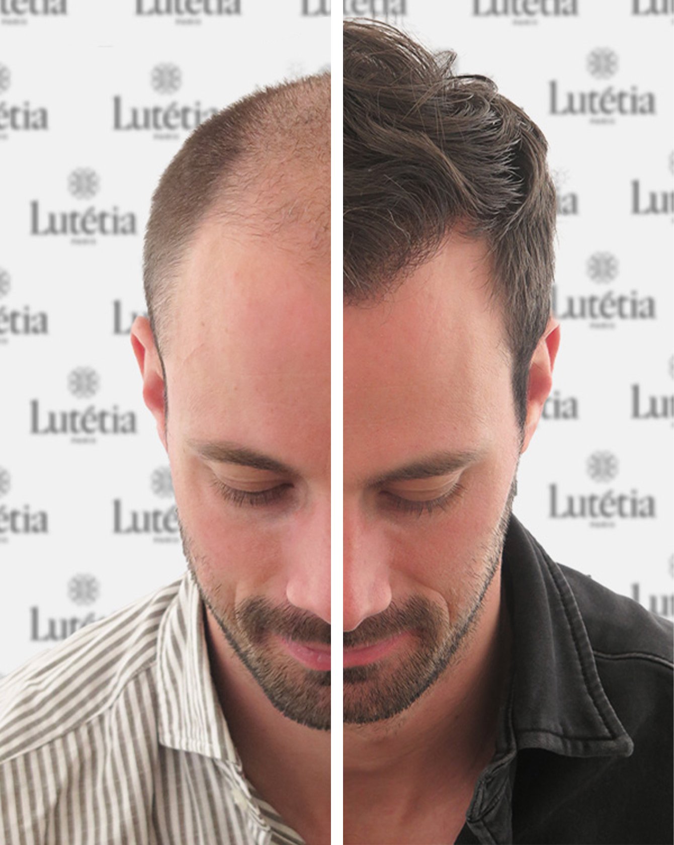 avant et après d'une greffe de cheveux sur un homme