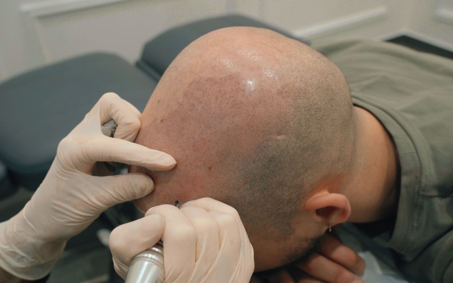 Micropigmentation capillaire et tatouage des cheveux