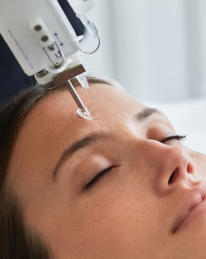 injection micro-dosées d'acide hyaluronique sur le front 