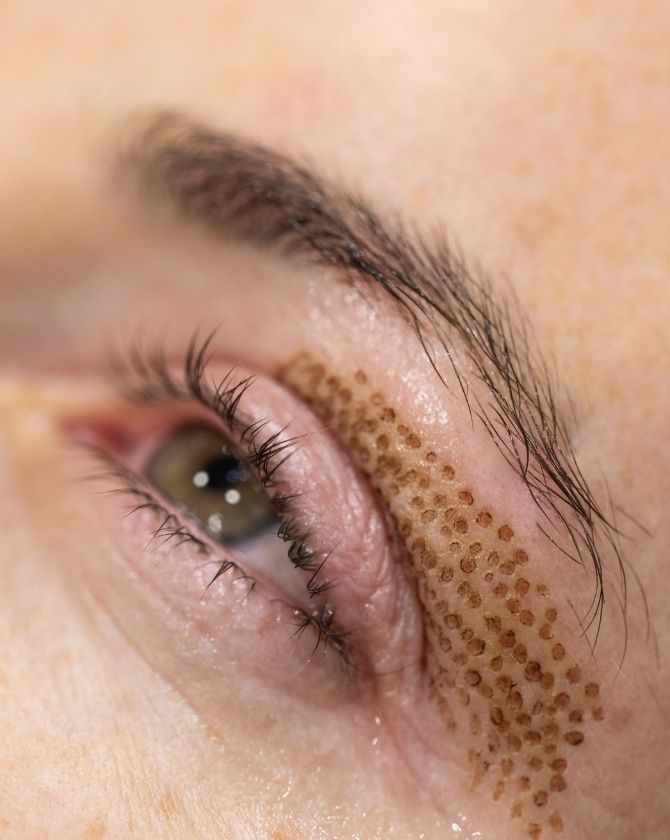 blépharoplastie lifting des yeux sans chirurgie par la maison lutetia