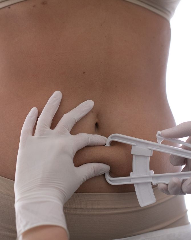 Résultat visible d'une silhouette affinée après plusieurs séances de cryolipolyse