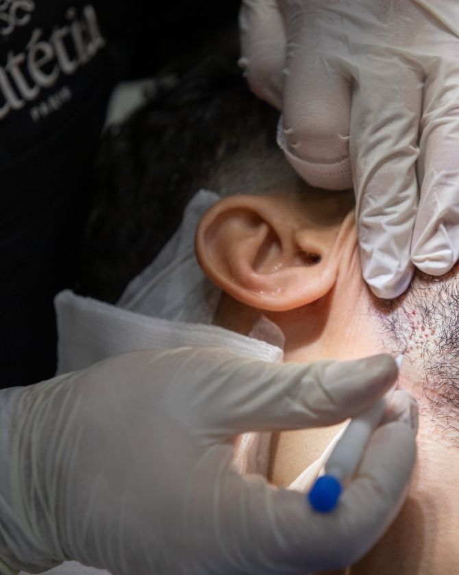 implantation de follicules sur une machoire par maison lutetia