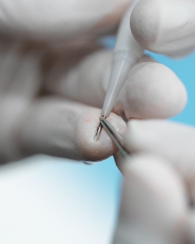 injecteur DHI pour follicules