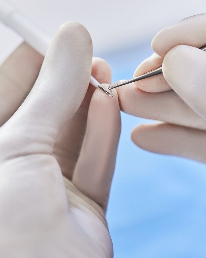 procédure de traitement des cellules souches des cheveux
