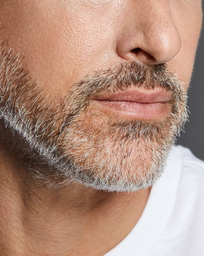 résultat d'implant de barbe paris