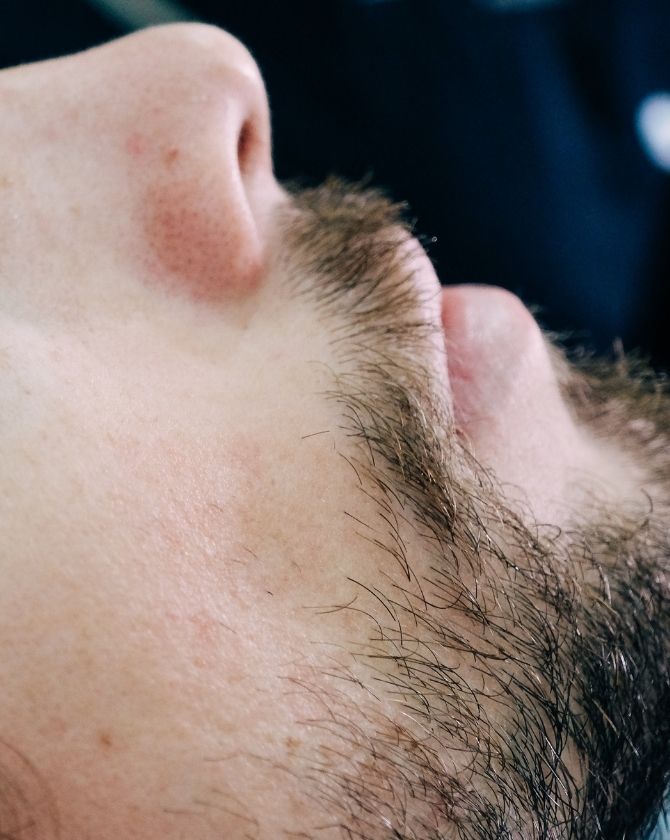 aaplication laser IPL chez l'homme